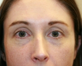 Feel Beautiful - Filler for darkness of lower eyelids - Before Photo
